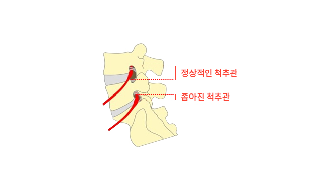 시술 전 추간공 협착