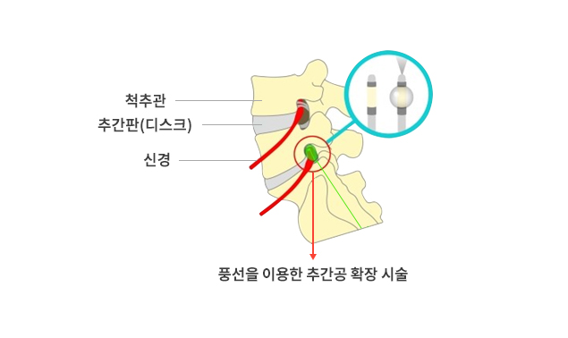 풍선 이용한 추간공 확장 시술